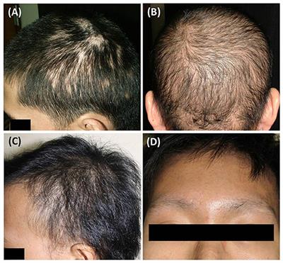 Epidemiological, Clinical, and Trichoscopic Features of Syphilitic Alopecia: A Retrospective Analysis and Systematic Review